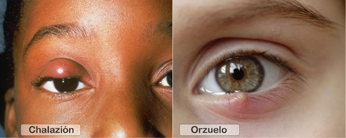 ¿Cuál es la diferencia entre un orzuelo y un chalazión?